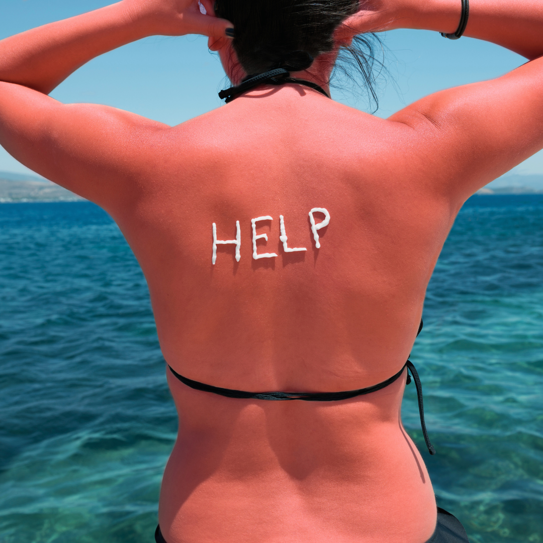 woman at ocean with sunburn