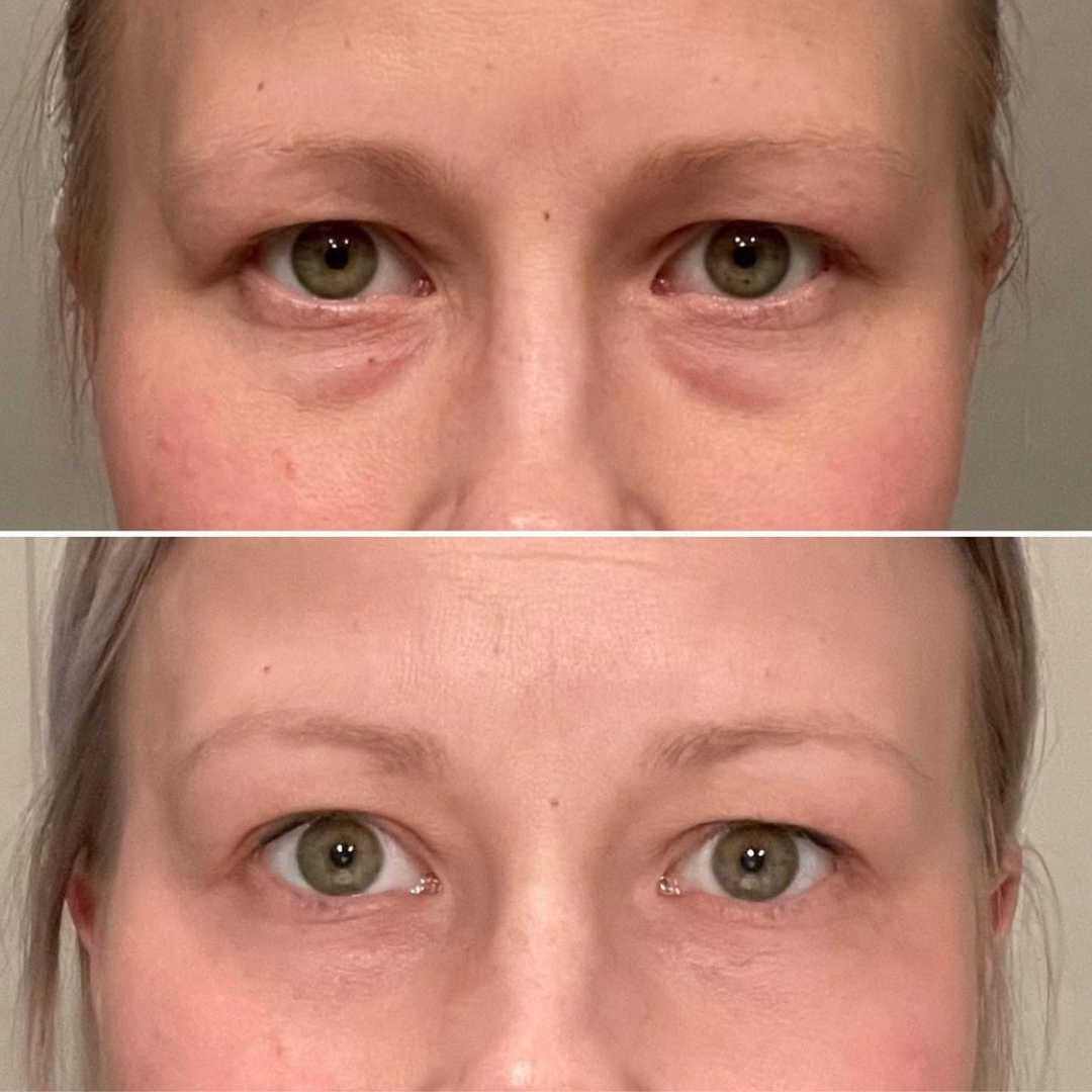 woman using fotona smootheye treatment